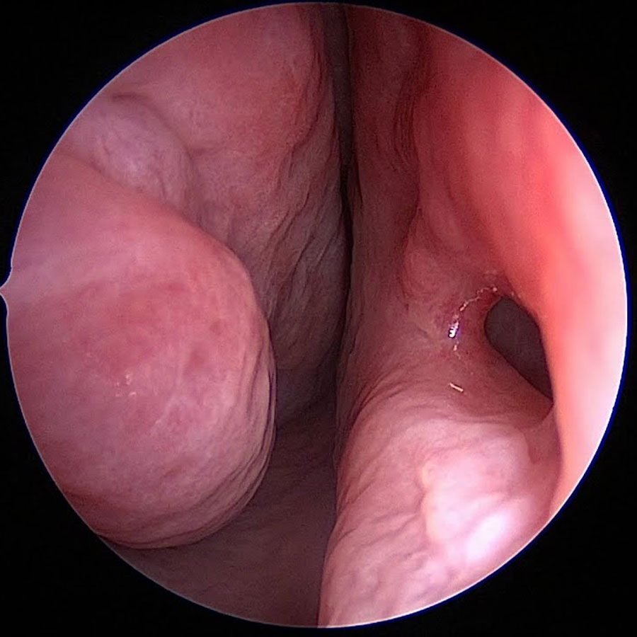 Nasal Septum Perforation